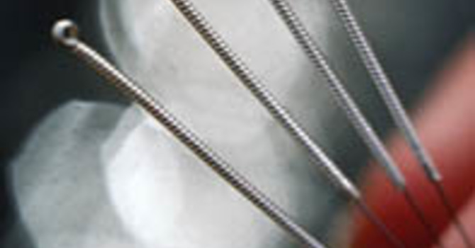 Acupuncture